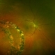 Bilateral Retinoschisis Retinal Detachment Bilateral Retinoschisis Retinal Detachment